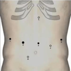 Picutre of Back Related to Technique for Robotic Transhiatal Esophagectomy